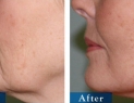 Natural-Looking Facelift Surgery 