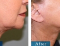 Edmonton &amp; Area Facelift Surgery 